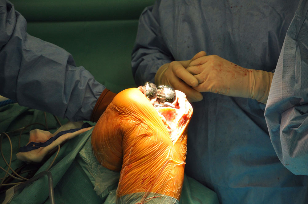 Protesi ginocchio intervento chirurgico