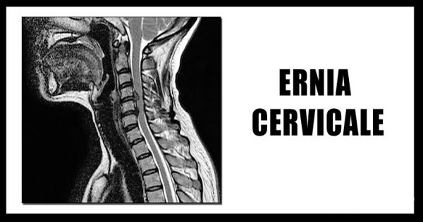 Ernia Cervicale Sintomi Cause E Rimedi Medicinafisica It