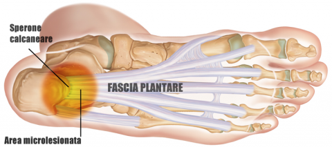 Fascite plantare i SINTOMI e i RIMEDI più efficaci Medicinafisica it